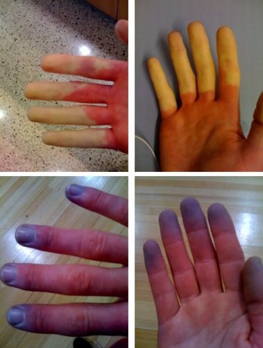 Raynaud's_Syndrome